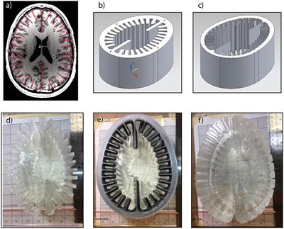 Sulcal Cavitation in Linear Head Acceleration: Possible Correlation With Chronic Traumatic Encephalopathy